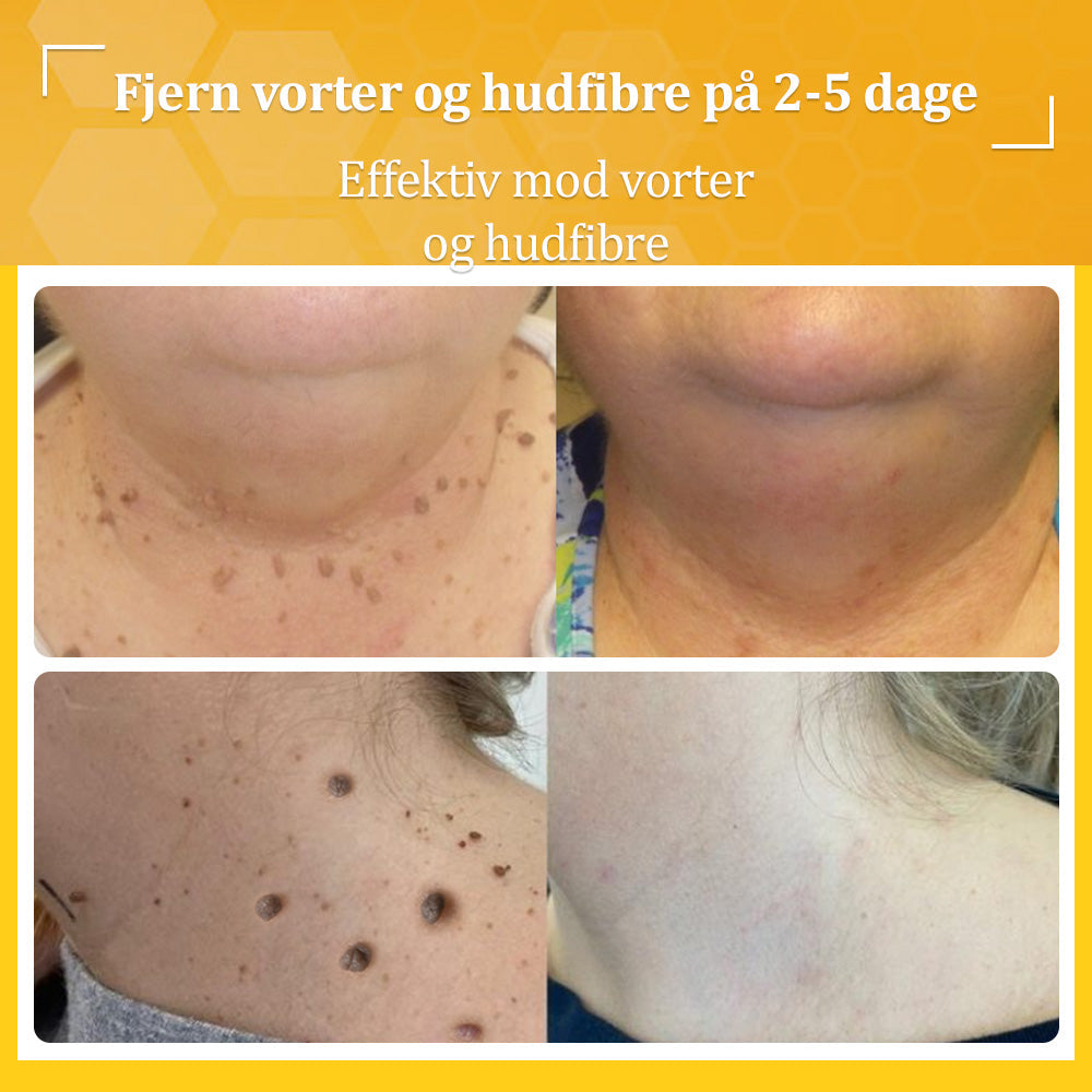 Stærk Bee Gift Creme–Hjælper med at behandle vedvarende vorter, hudvækster, hudlæsioner, infektioner, ardannelse og udglatte ujævn hud👨⚕️