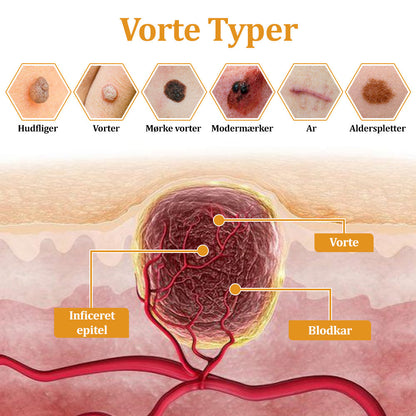 Stærk Bee Gift Creme–Hjælper med at behandle vedvarende vorter, hudvækster, hudlæsioner, infektioner, ardannelse og udglatte ujævn hud👨‍⚕️