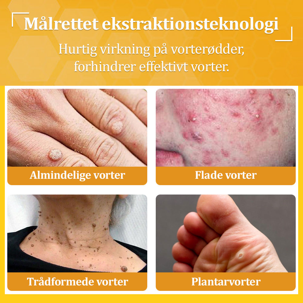 Stærk Bee Gift Creme–Hjælper med at behandle vedvarende vorter, hudvækster, hudlæsioner, infektioner, ardannelse og udglatte ujævn hud👨‍⚕️
