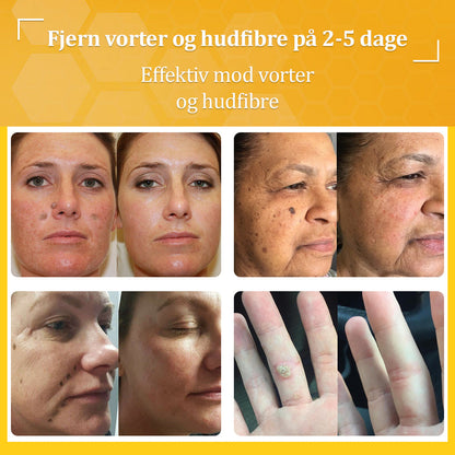 Stærk Bee Gift Creme–Hjælper med at behandle vedvarende vorter, hudvækster, hudlæsioner, infektioner, ardannelse og udglatte ujævn hud👨‍⚕️