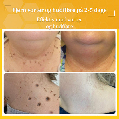 Stærk Bee Gift Creme–Hjælper med at behandle vedvarende vorter, hudvækster, hudlæsioner, infektioner, ardannelse og udglatte ujævn hud👨‍⚕️